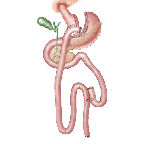 gastric bypass