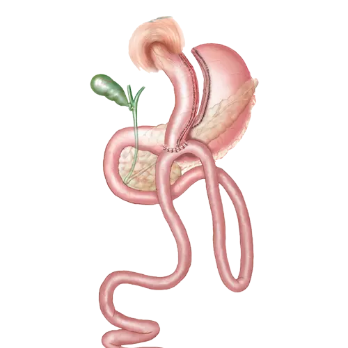 mini gastric bypass