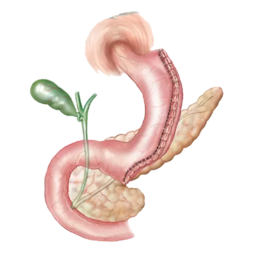 sleeve gastrectomy